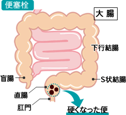 便塞栓