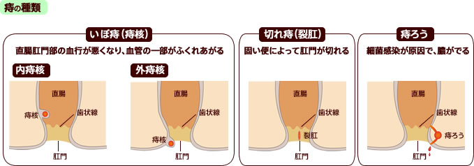 ボラギノール 効き目