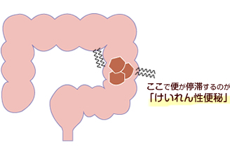 イチジク完腸 効き目